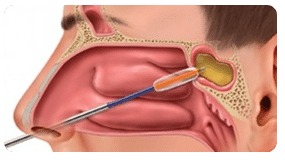 Sinuplasty on sale