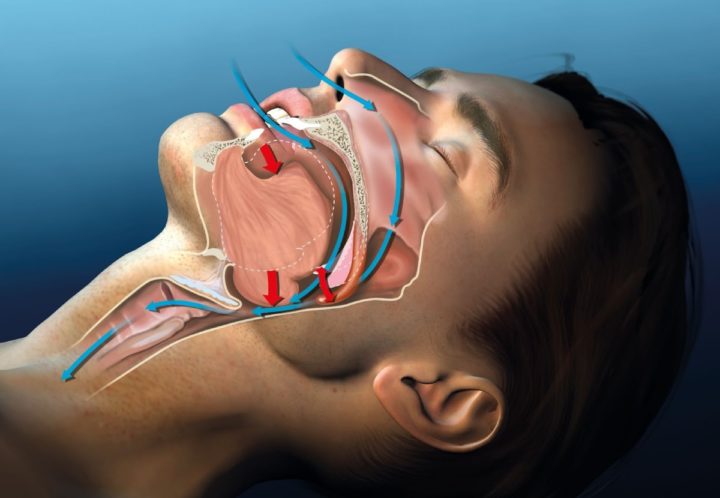 MIPS to reduce snoring