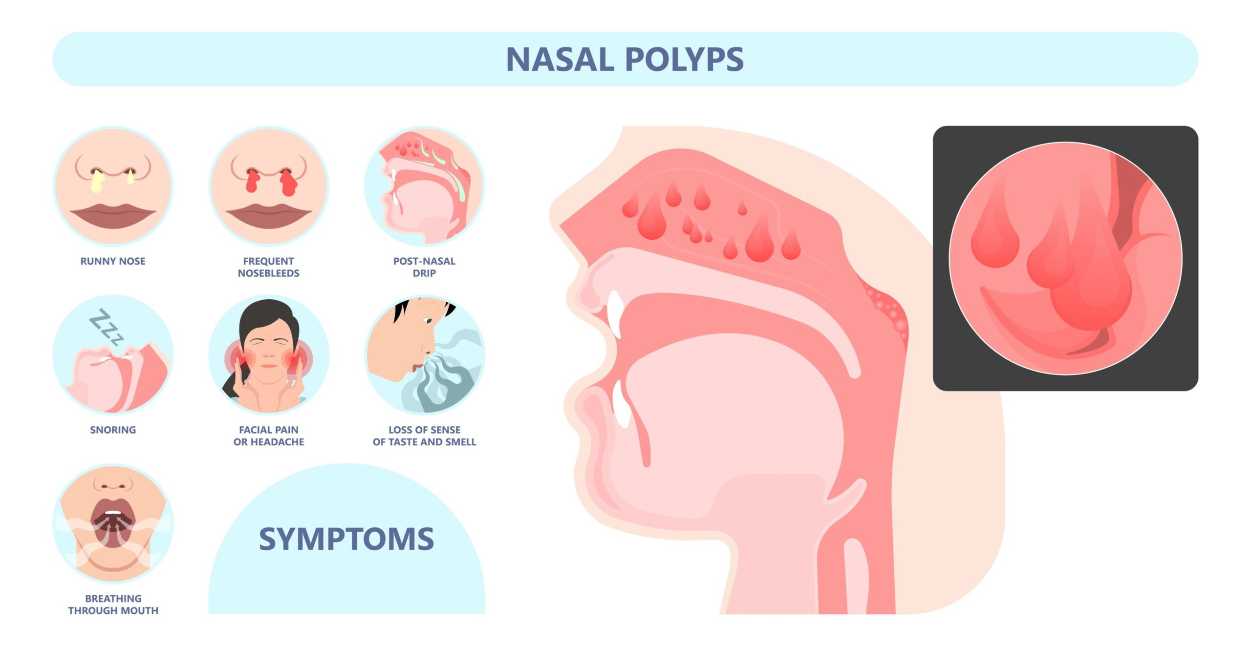 small polyps, specific allergens